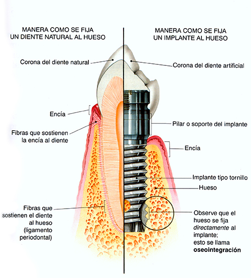 Implantología